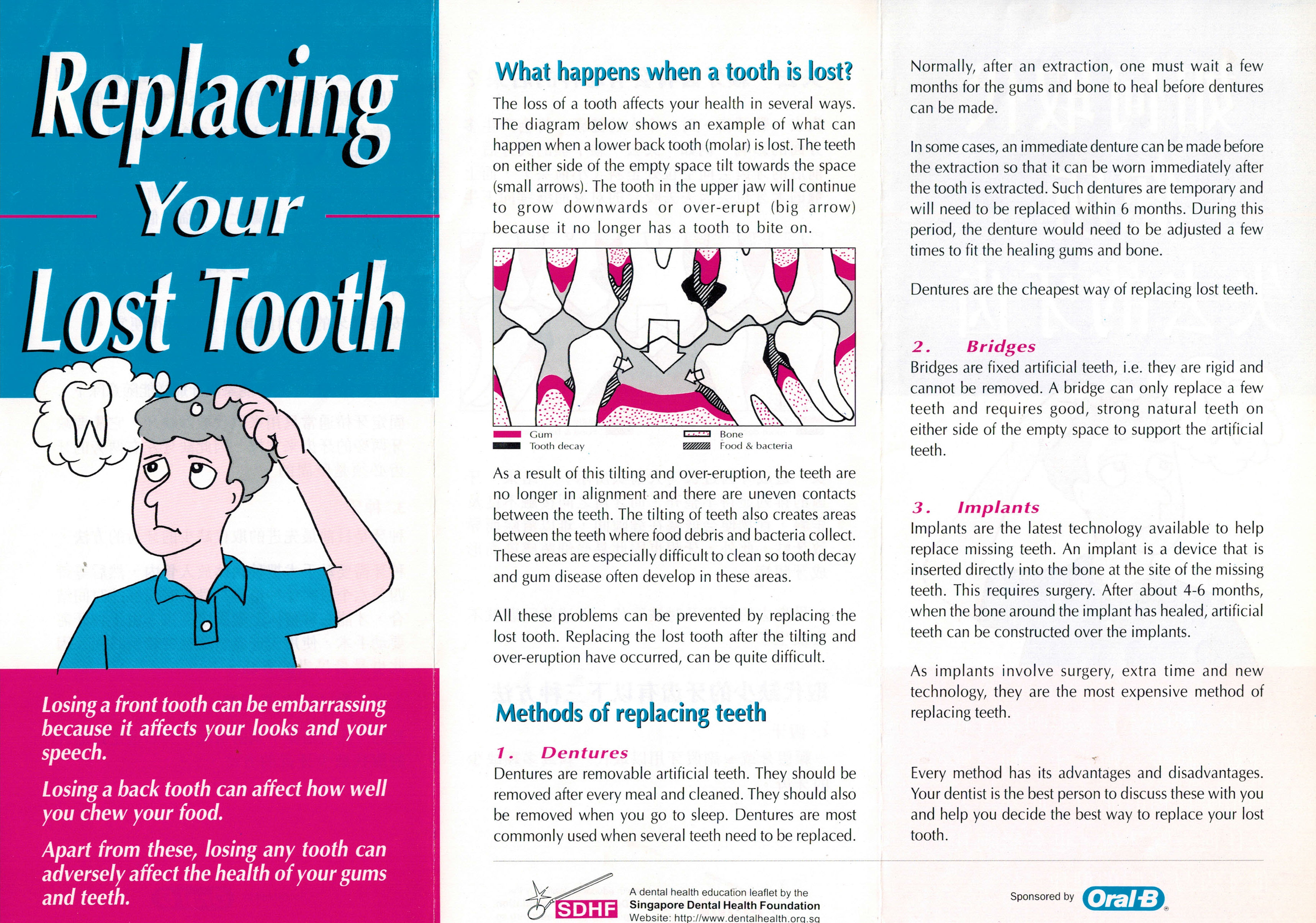 Replacing Your Lost Tooth